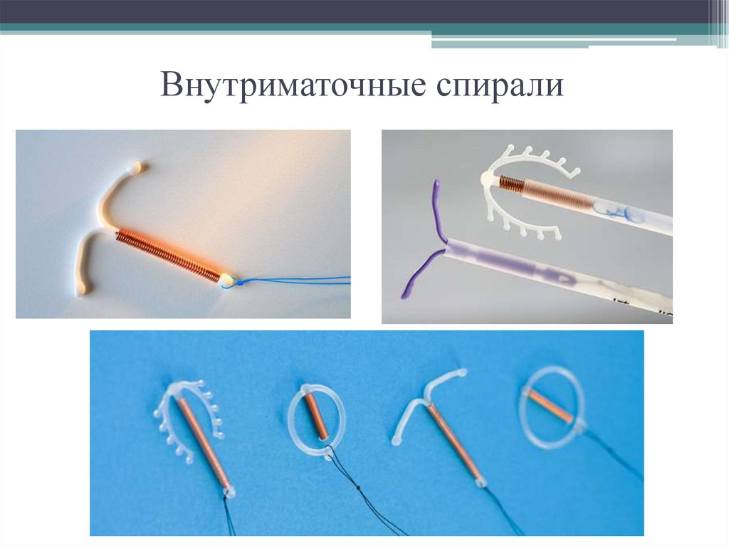 Спираль внутриматочная — виды, принцип действия и порядок установки